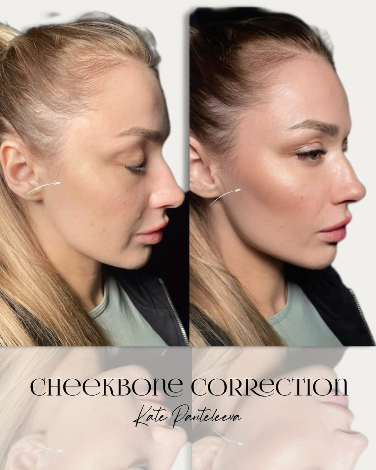 Cheekbones, before and after, patient of Dr Kate