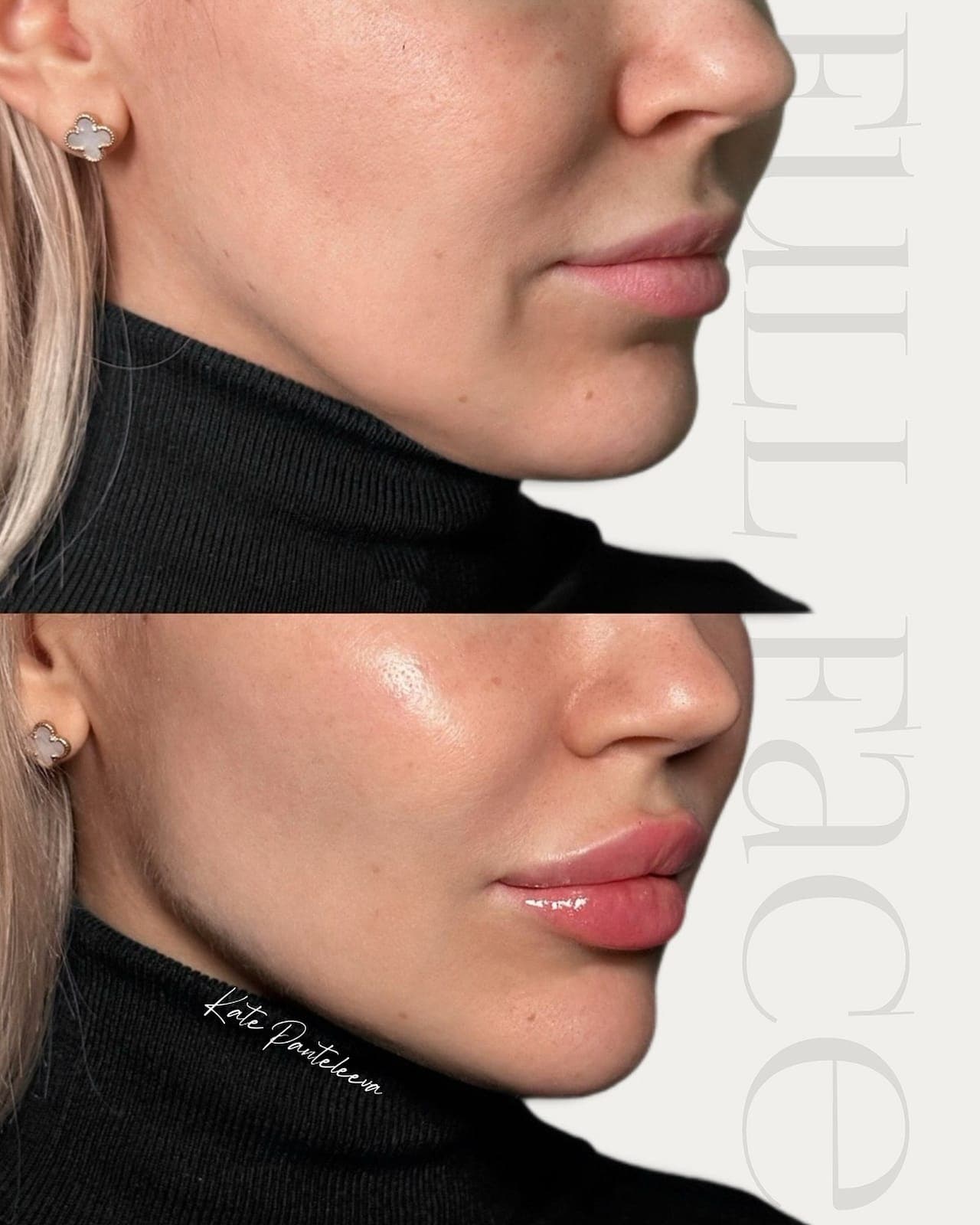 Full face, before and after, patient of Dr Kate