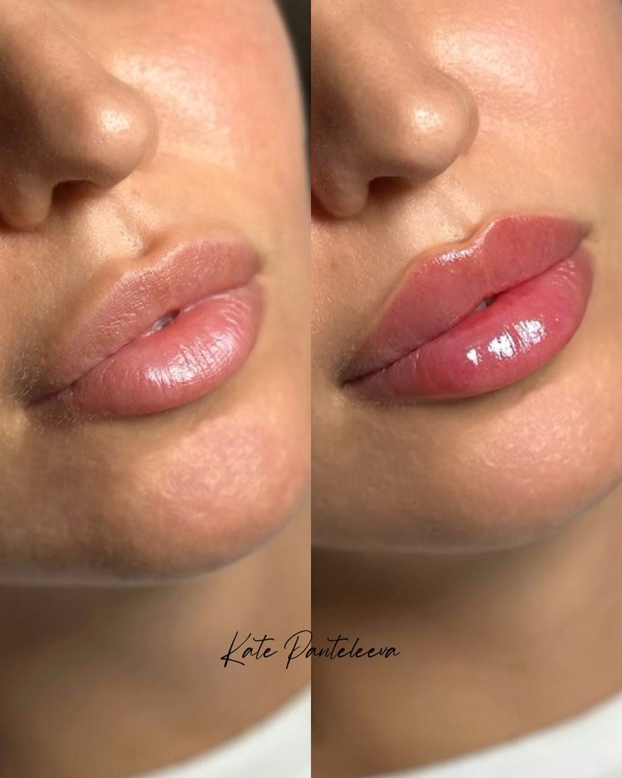 Lips, before and after, patient of Dr Kate