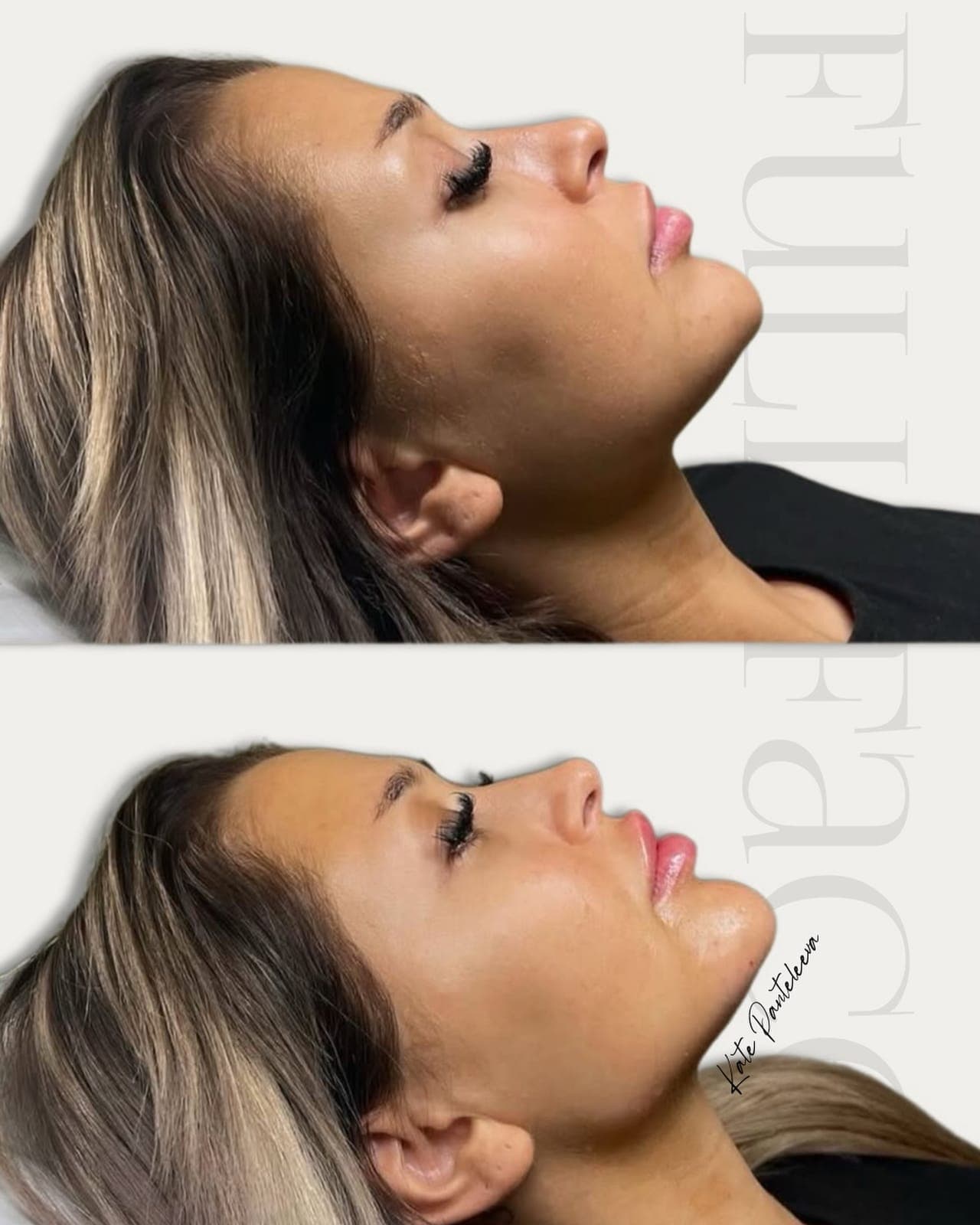 Full face, before and after, patient of Dr Kate