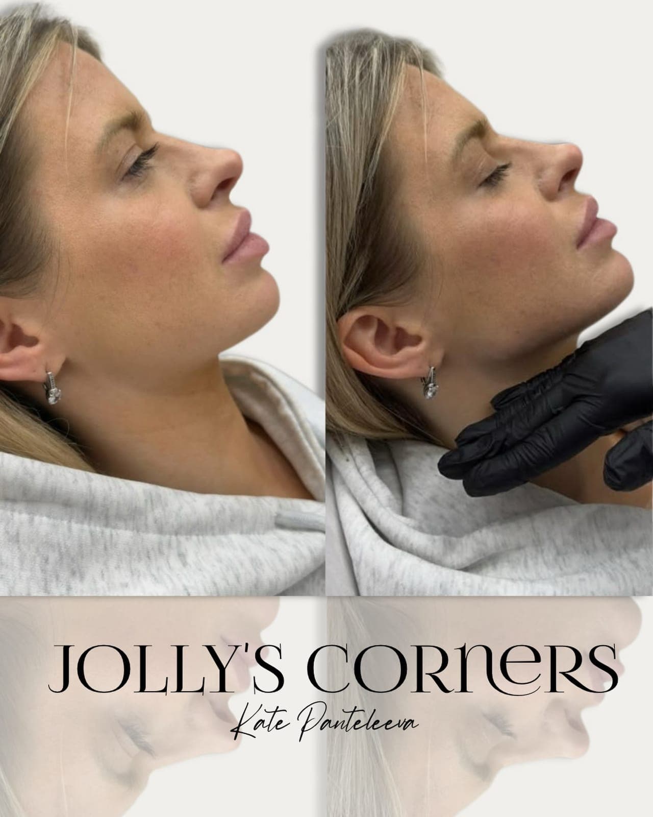 Jowl corners, before and after, patient of Dr Kate