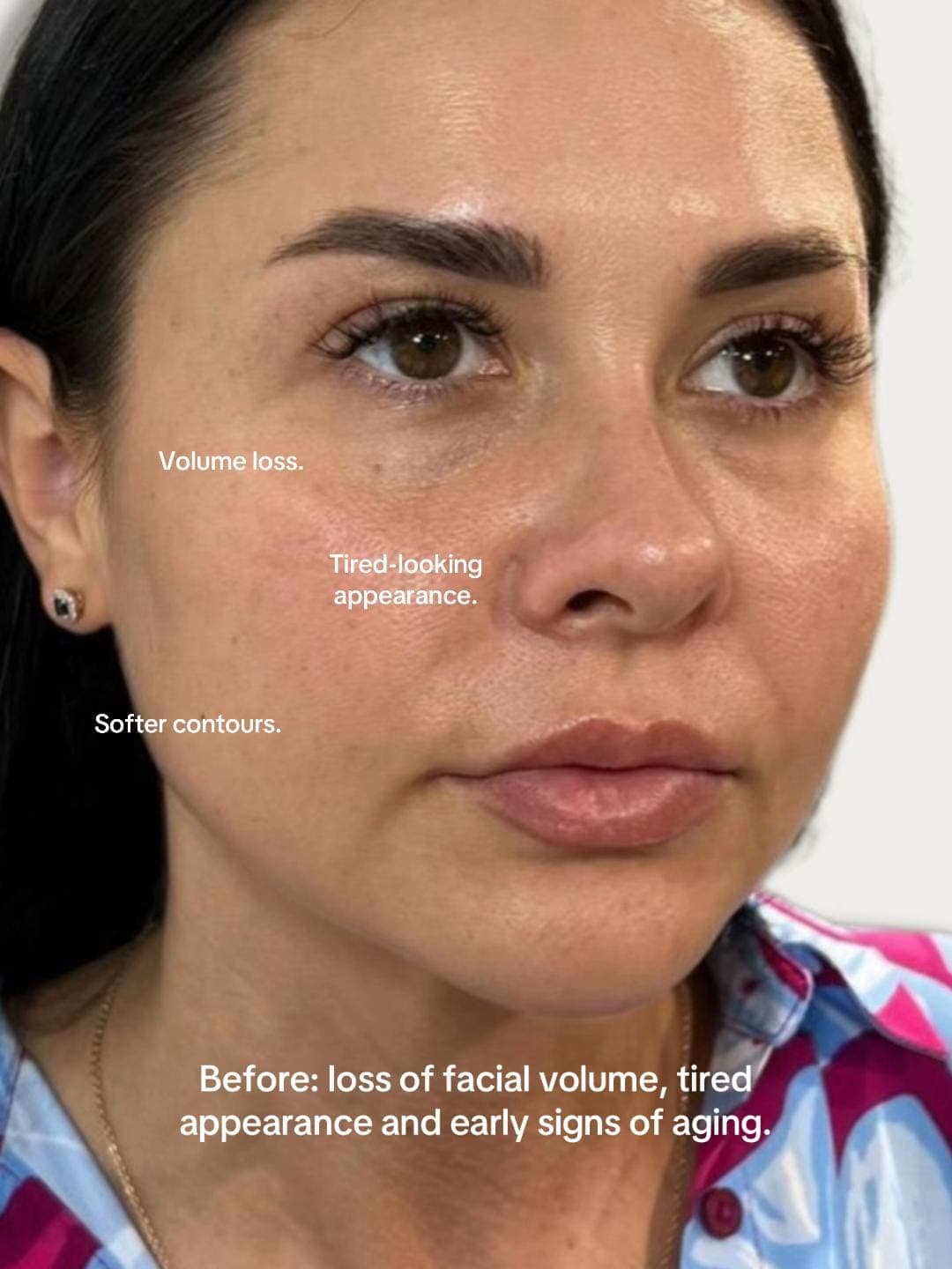 Full face, before, patient of Dr Kate