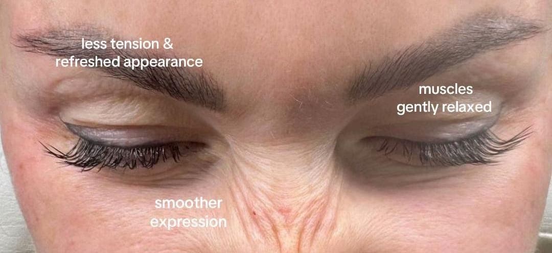 Glabella, after, patient of Dr Kate