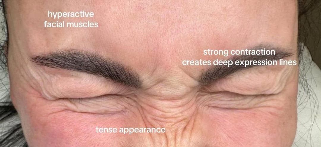 Glabella, before, patient of Dr Kate