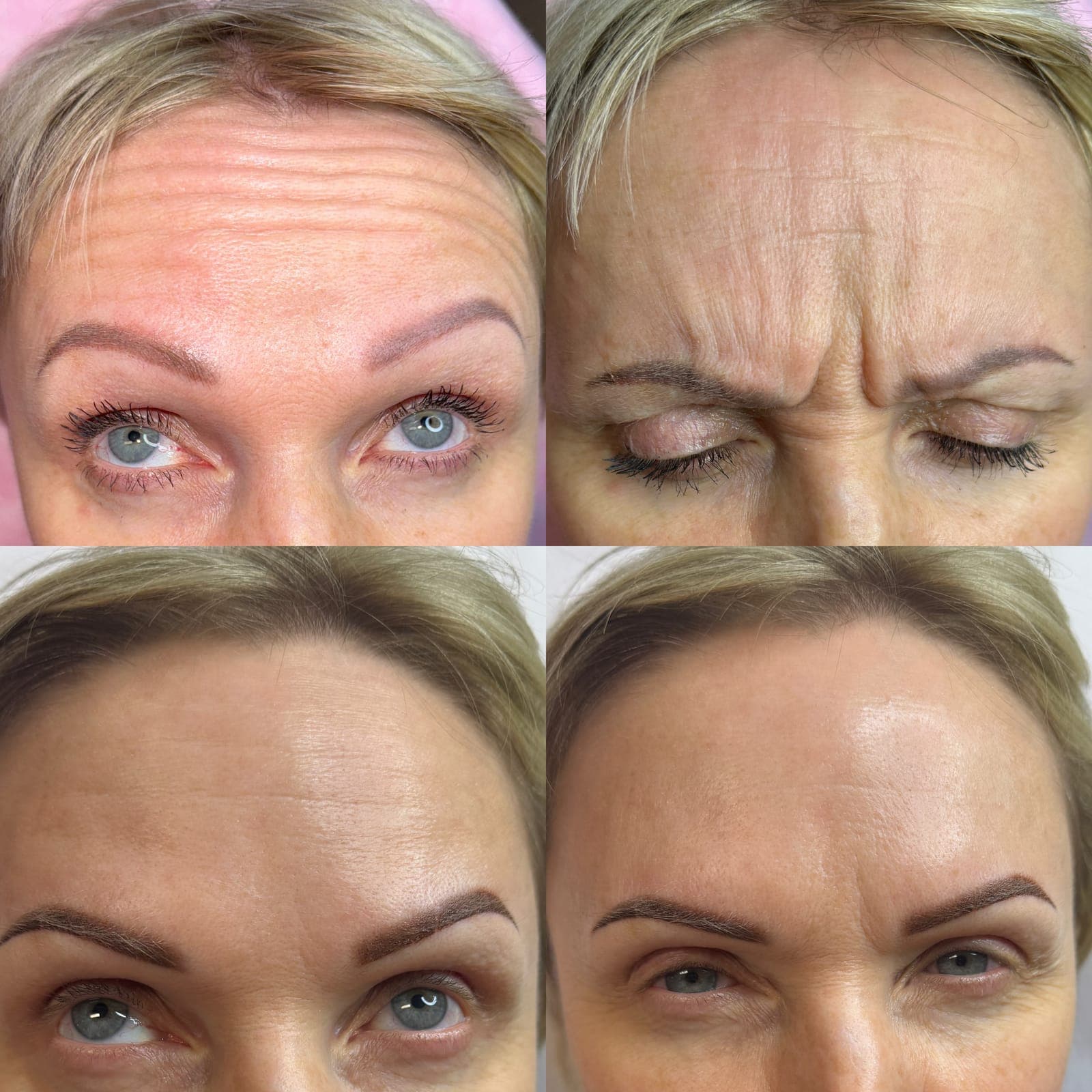 Forehead and frown lines, before and after, patient of Dr Kate