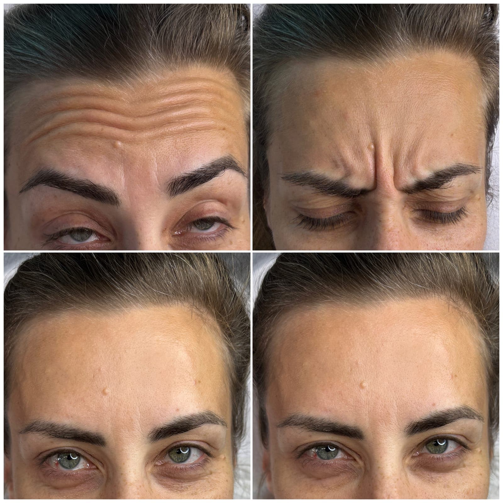Forehead and frown lines, before and after, patient of Dr Kate