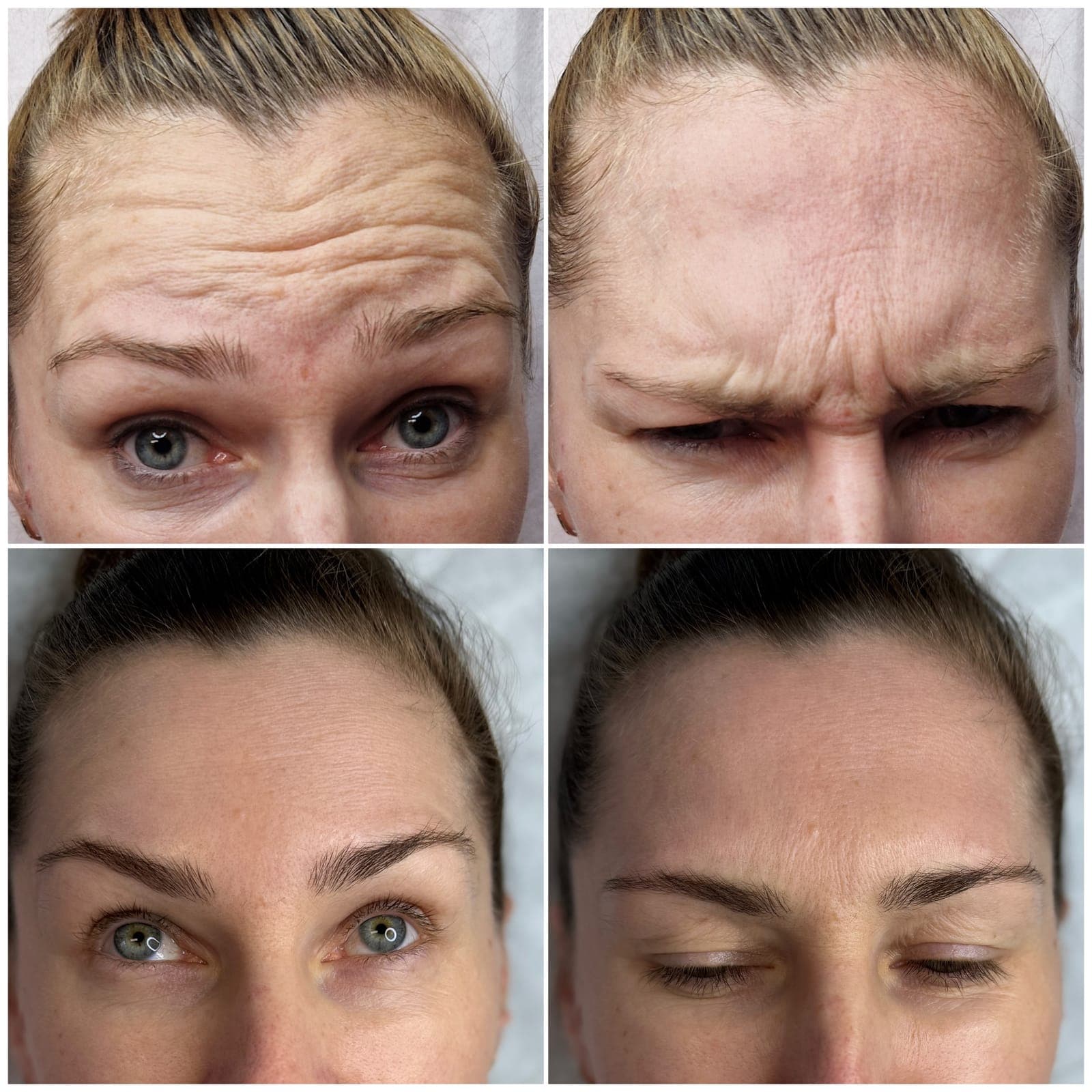 Forehead and frown lines, before and after, patient of Dr Kate
