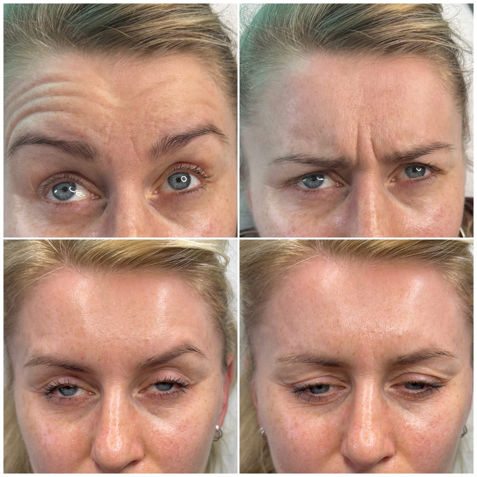 Forehead and frown lines, before and after, patient of Dr Kate