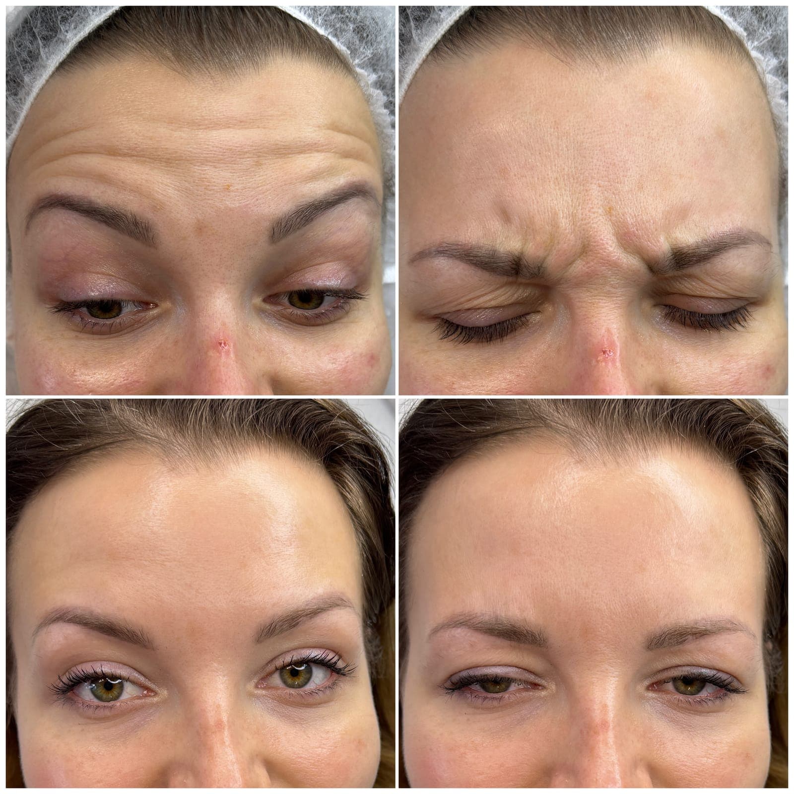 Forehead and frown lines, before and after, patient of Dr Kate