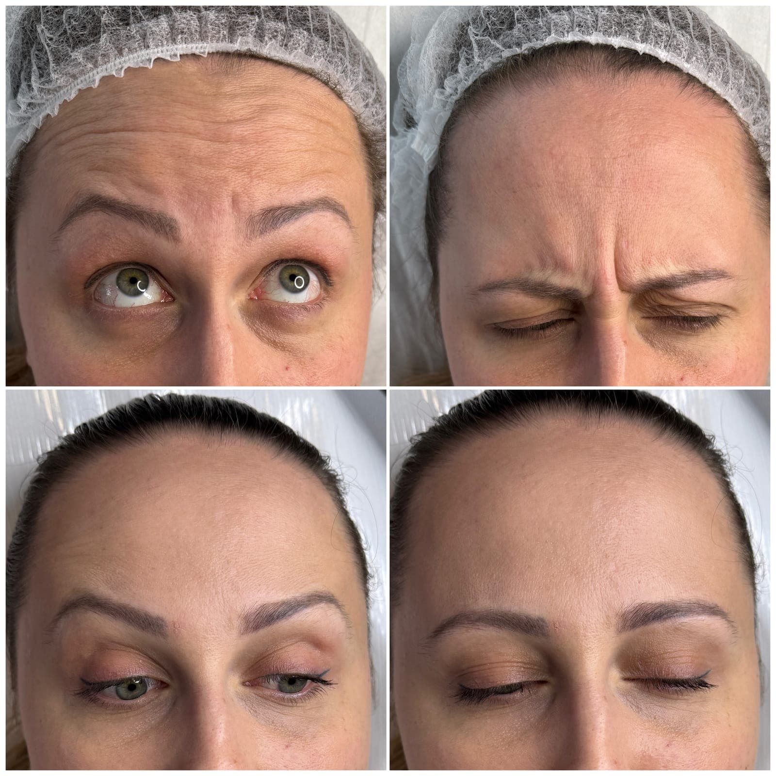 Forehead and frown lines, before and after, patient of Dr Kate