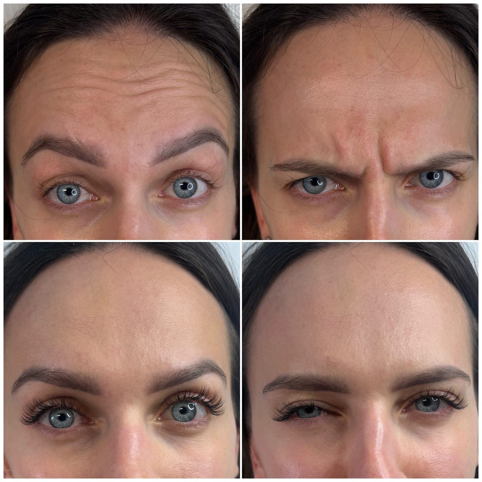 Forehead and frown lines, before and after, patient of Dr Kate