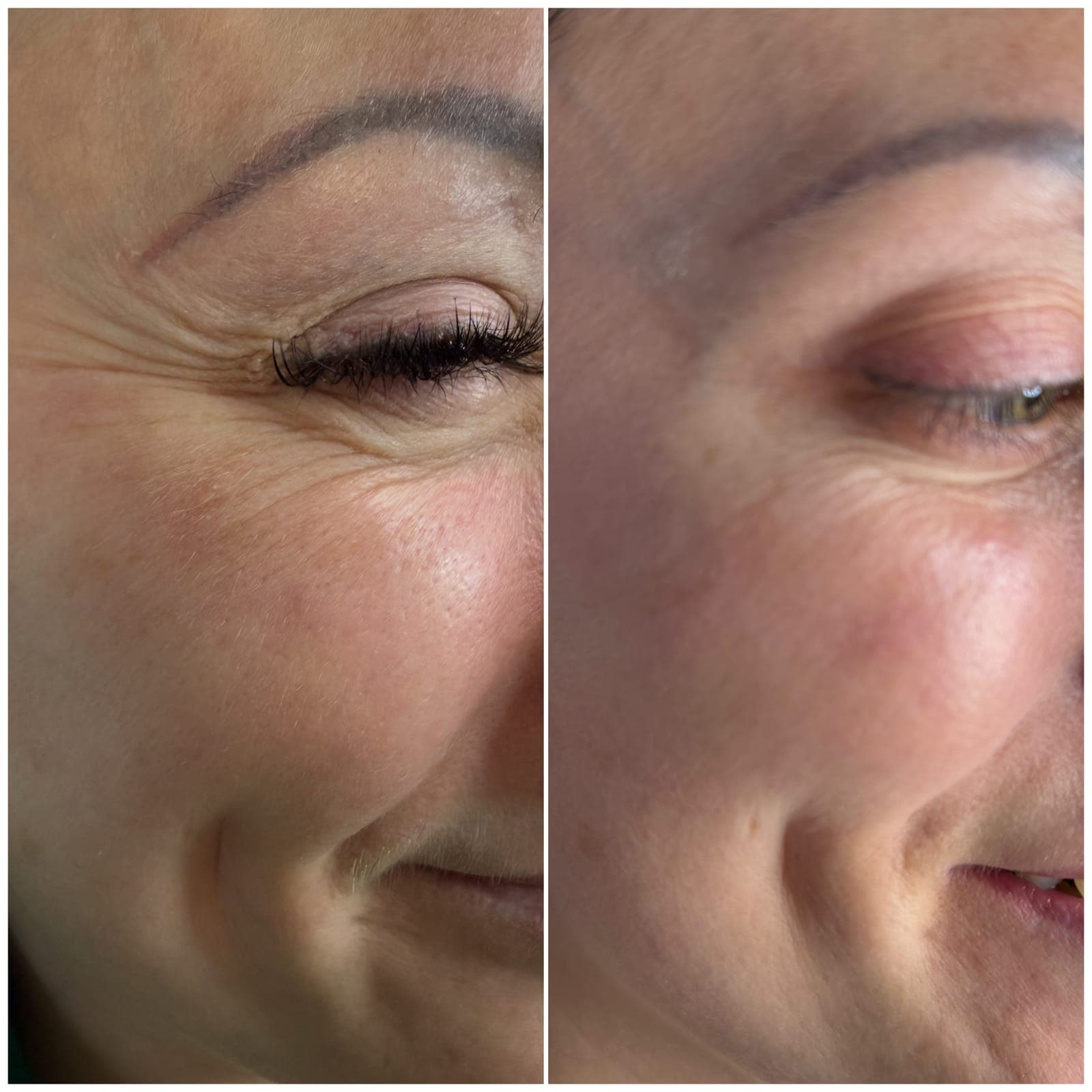 Crow's feet, two photos of the same patient, patient of Dr Kate