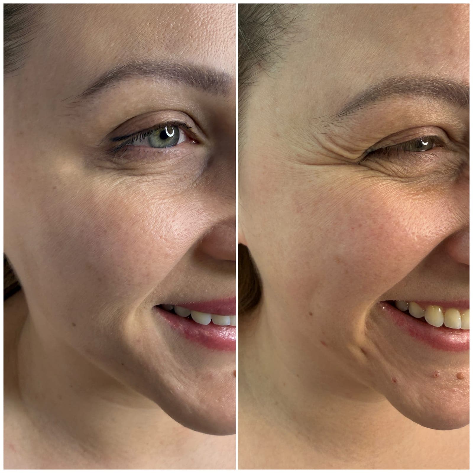 Crow's feet, two photos of the same patient, patient of Dr Kate